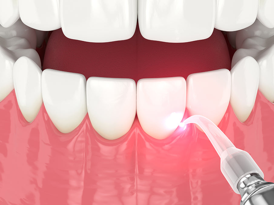 The Advantages of Soft Tissue Diode Lasers for Gingivectomy