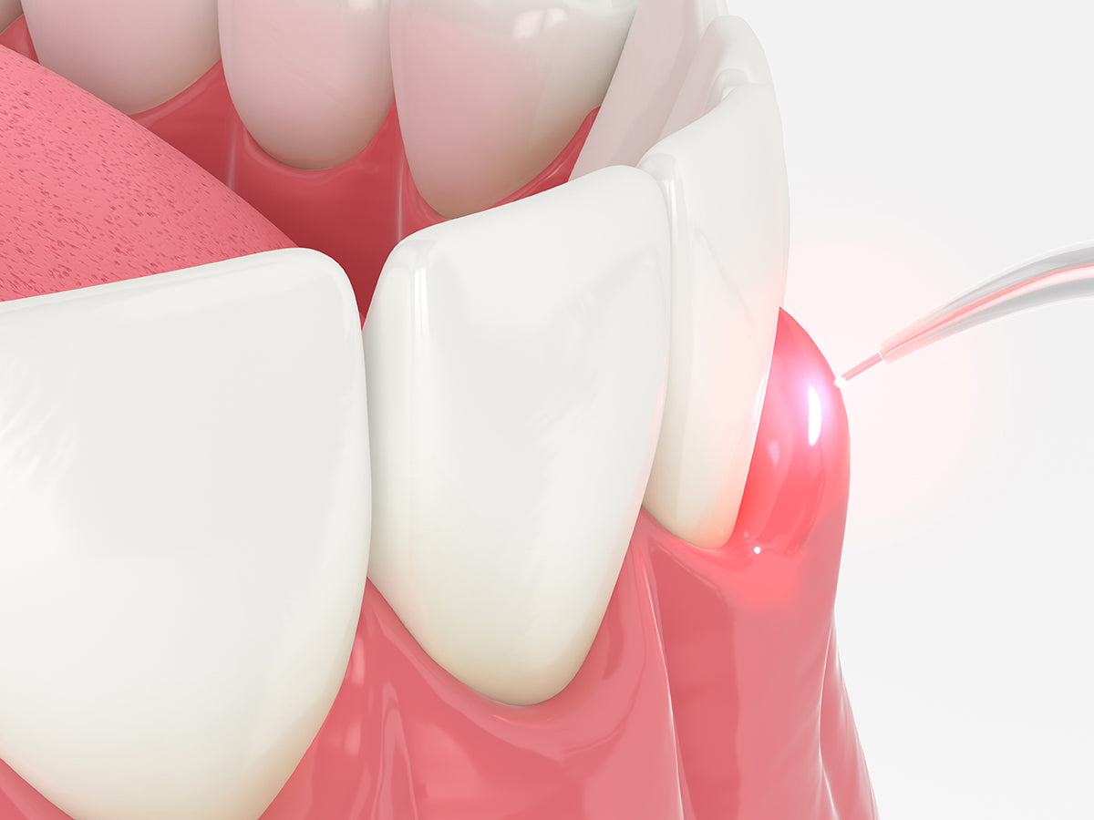 Hyperplasia Treatment Made Easier and Efficient with 810 nm Diode Laser